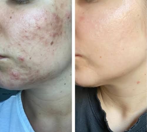 Lovvish Korean Collagen Mask™